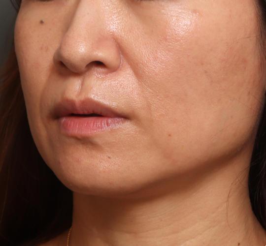 40代女性のヒアルロン酸注射（ほうれい線） Before 症例写真