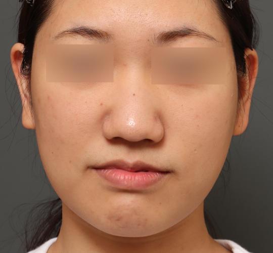 20代女性の美肌治療 After 症例写真