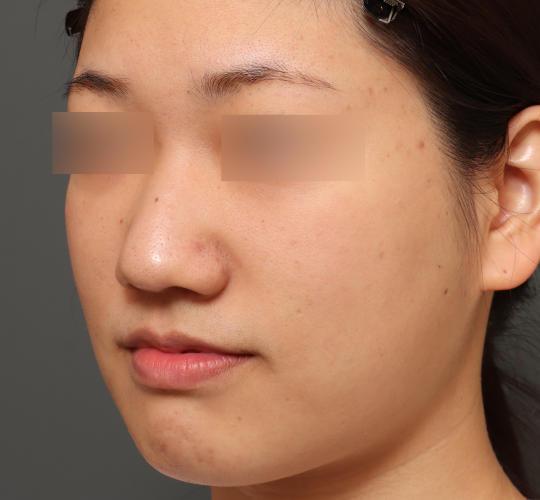 20代女性の肌管理毛穴スリークスキン（ダーマペン4） After 症例写真