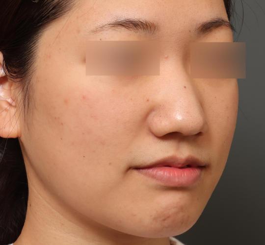 20代女性の肌管理毛穴スリークスキン（ダーマペン4） After 症例写真