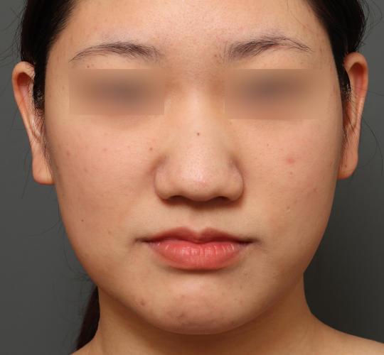 20代女性の美肌治療 Before 症例写真