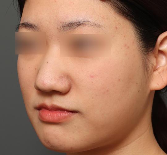 20代女性の肌管理毛穴スリークスキン（ダーマペン4） Before 症例写真