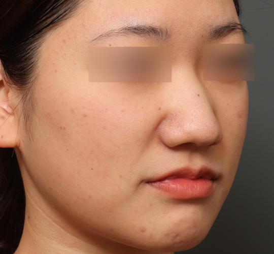 20代女性の肌管理毛穴スリークスキン（ダーマペン4） Before 症例写真