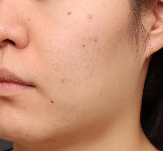 20代女性の肌管理毛穴スリークスキン（ダーマペン4） After 症例写真