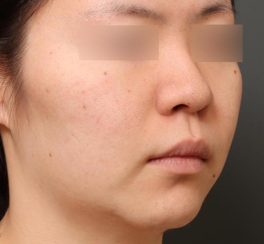 20代女性の美肌治療 After 症例写真