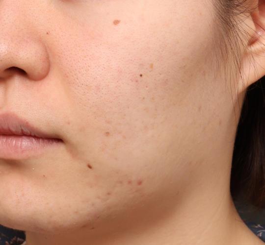 20代女性の肌管理毛穴スリークスキン（ダーマペン4） Before 症例写真