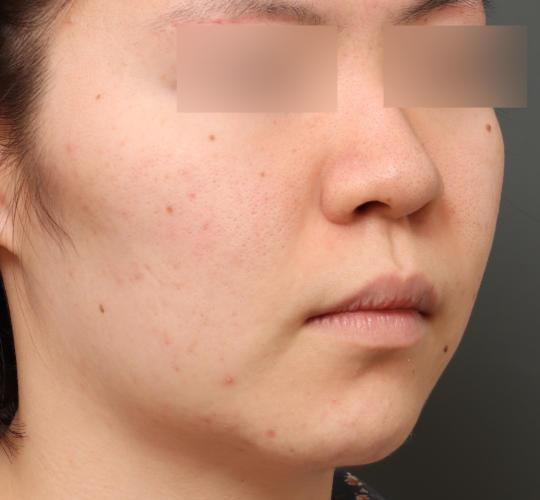 20代女性の美肌治療 Before 症例写真