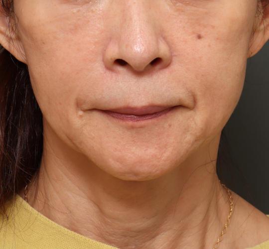 60代女性のVOVリフトプレミアム After 症例写真