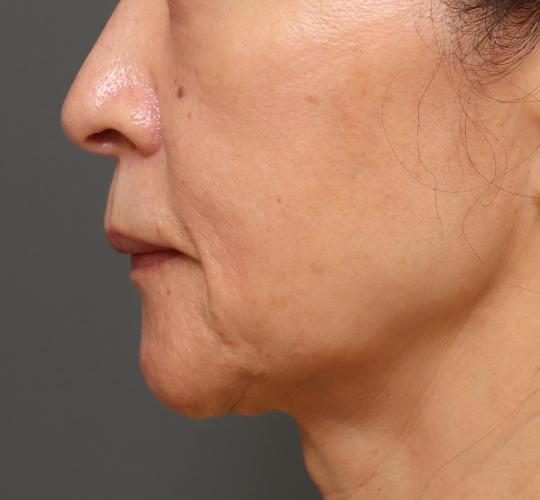 60代女性のVOVリフトプレミアム After 症例写真