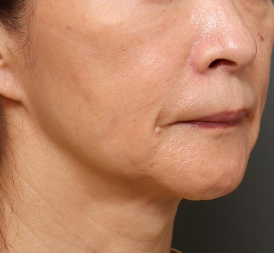 60代女性のVOVリフトプレミアム After 症例写真