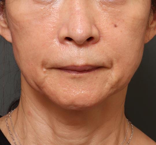 60代女性のVOVリフトプレミアム Before 症例写真