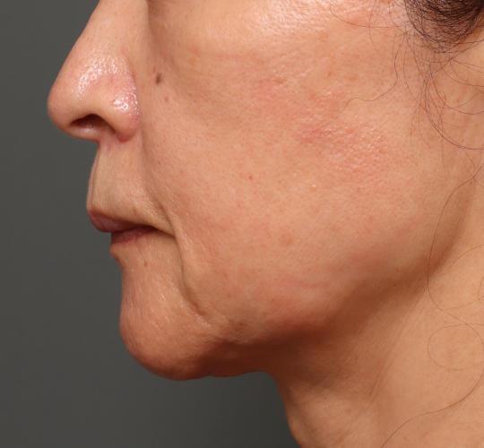 60代女性のVOVリフトプレミアム Before 症例写真