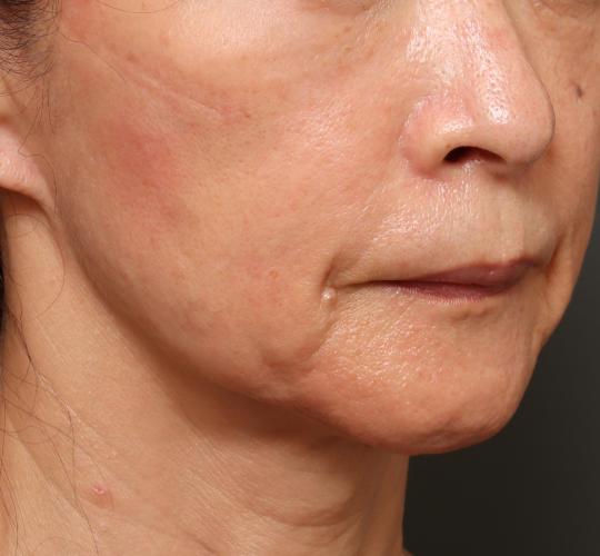 60代女性のVOVリフトプレミアム Before 症例写真