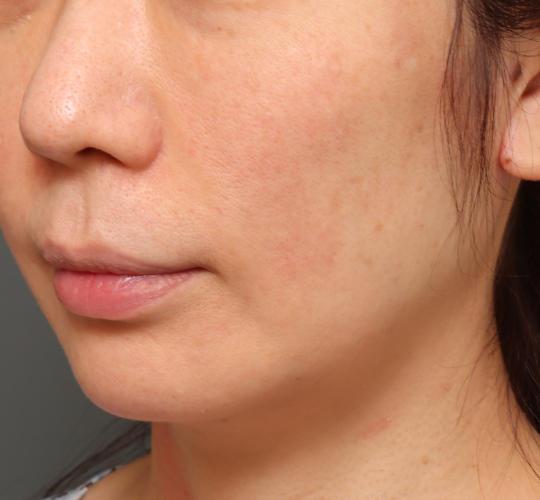 40代女性のVOVリフトプレミアム After 症例写真