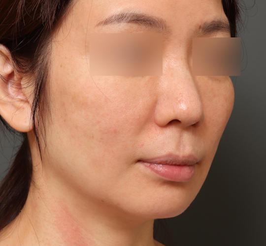 40代女性のVOVリフトプレミアム After 症例写真