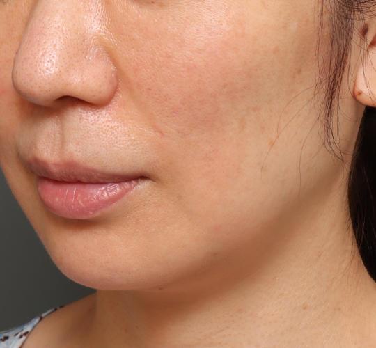 40代女性のVOVリフトプレミアム Before 症例写真