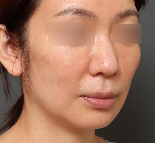 40代女性のVOVリフトプレミアム Before 症例写真