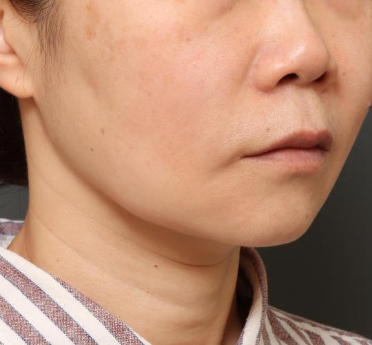 40代女性のVOVリフトプレミアム After 症例写真