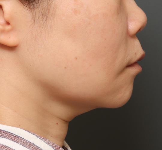 40代女性のVOVリフトプレミアム After 症例写真