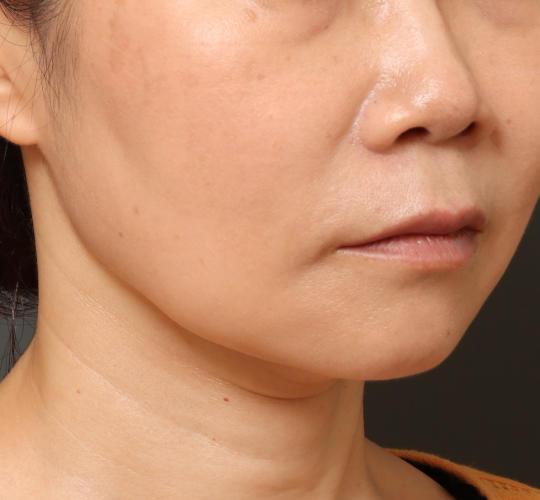 40代女性のVOVリフトプレミアム Before 症例写真