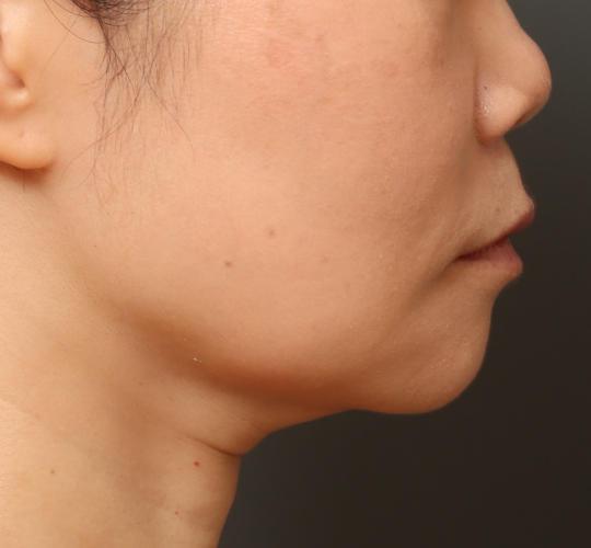 40代女性のVOVリフトプレミアム Before 症例写真