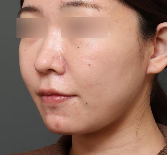 30代女性の二重アゴ筋肉縛り（ペリカン手術） After 症例写真
