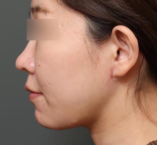 30代女性の二重アゴ筋肉縛り（ペリカン手術） After 症例写真