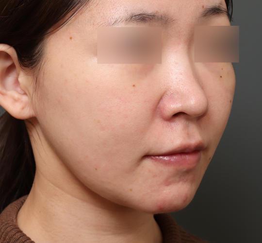 30代女性の二重アゴ筋肉縛り（ペリカン手術） After 症例写真