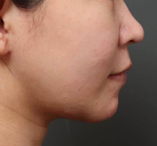 30代女性の二重アゴ筋肉縛り（ペリカン手術） After 症例写真
