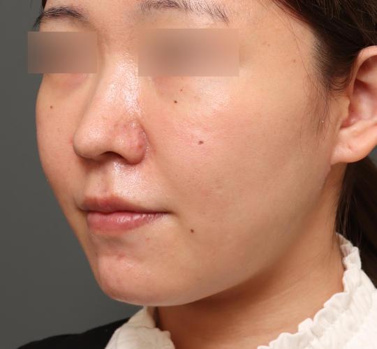 30代女性の二重アゴ筋肉縛り（ペリカン手術） Before 症例写真