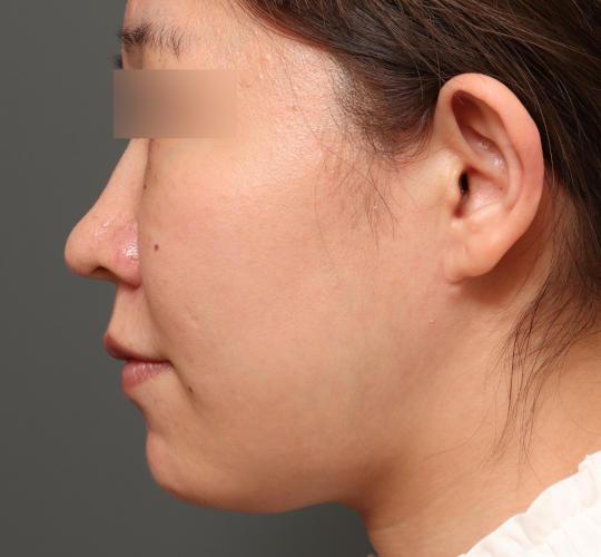 30代女性の二重アゴ筋肉縛り（ペリカン手術） Before 症例写真