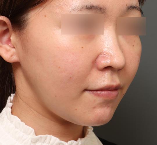 30代女性の二重アゴ筋肉縛り（ペリカン手術） Before 症例写真