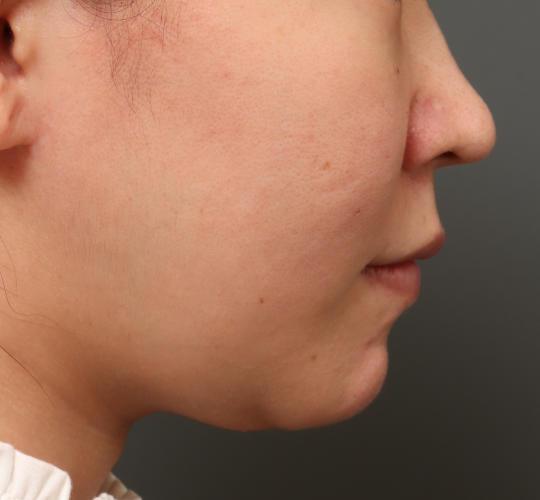 30代女性の二重アゴ筋肉縛り（ペリカン手術） Before 症例写真