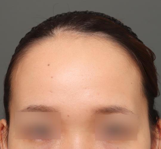 20代女性のエラ・アゴ・小顔 Before 症例写真