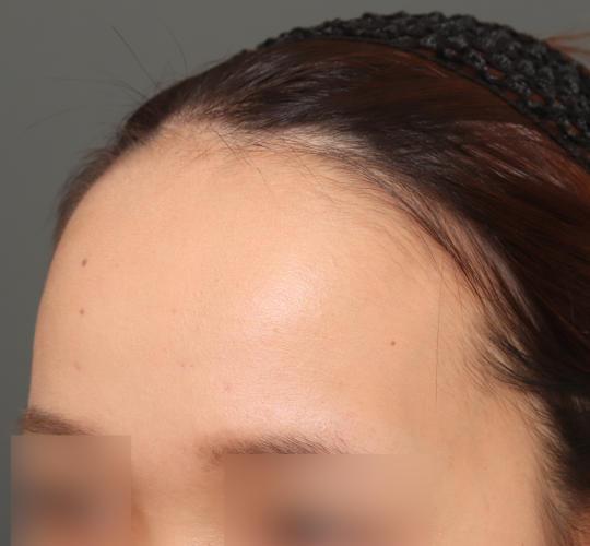 20代女性の額縮小 Before 症例写真