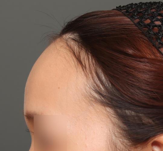 20代女性の額縮小 Before 症例写真