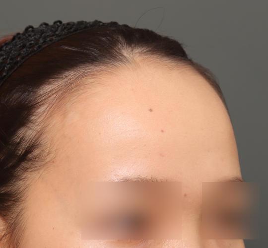 20代女性の額縮小 Before 症例写真