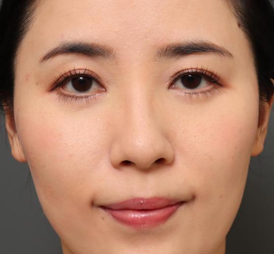 30代女性の下まぶたのたるみ取り After 症例写真