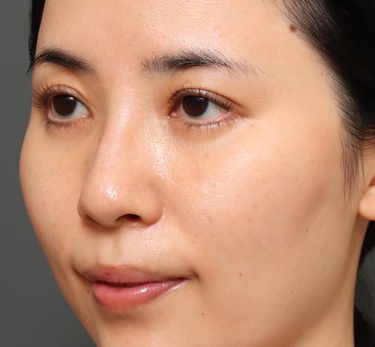 30代女性の下まぶたのたるみ取り After 症例写真