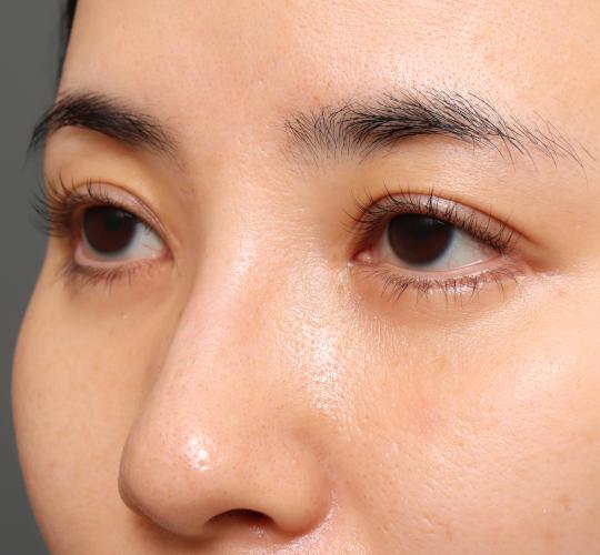 30代女性の二重整形・目元の整形 After 症例写真