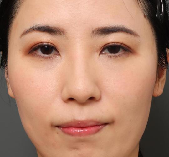 30代女性の下まぶたのたるみ取り Before 症例写真