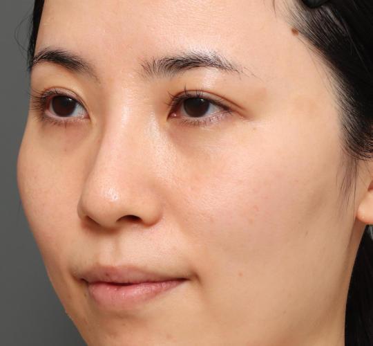 30代女性の下まぶたのたるみ取り Before 症例写真