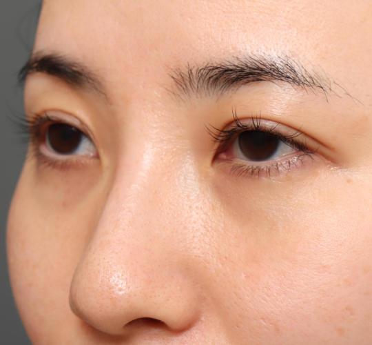 30代女性の二重整形・目元の整形 Before 症例写真