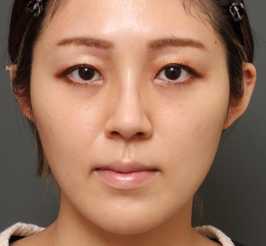 30代女性の顔の脂肪吸引  After 症例写真