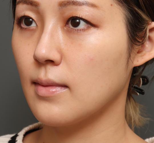 30代女性の顔の脂肪吸引  After 症例写真