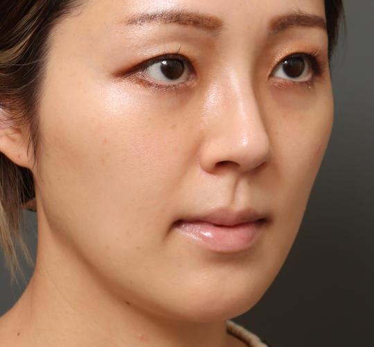 30代女性の顔の脂肪吸引  After 症例写真