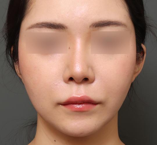 20代女性の鼻中隔延長 After 症例写真