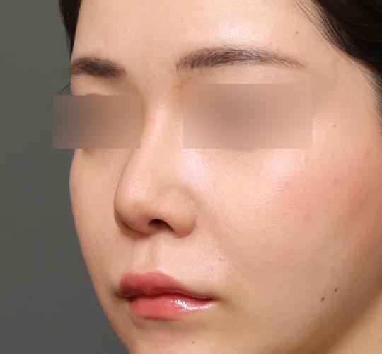 20代女性の鼻中隔延長 After 症例写真