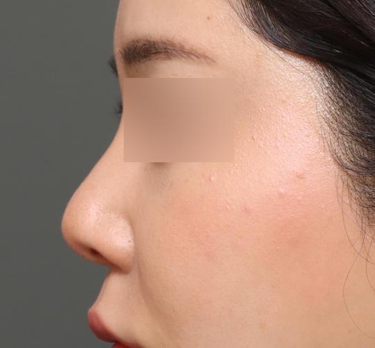 20代女性の鼻中隔延長 After 症例写真
