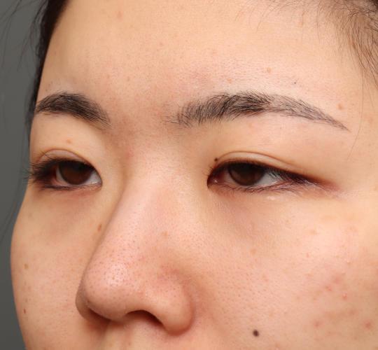 20代女性の目つき矯正 Before 症例写真